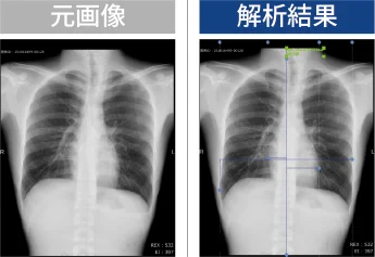 胸部X線CTR推定