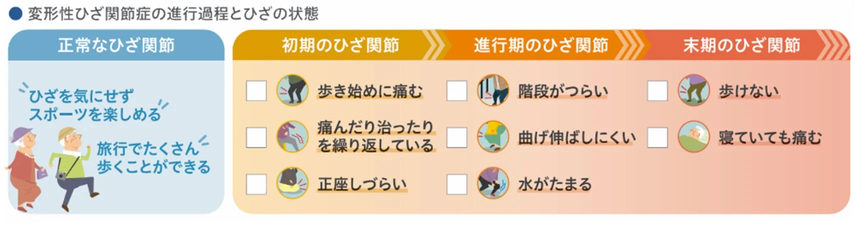 変形性ひざ関節症の進行過程とひざの状態