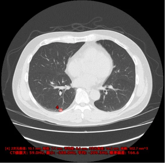 胸部CT画像診断支援AI「EIRL Chest CT」の計測機能のイメージ