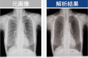 胸部X線画像解析比較
