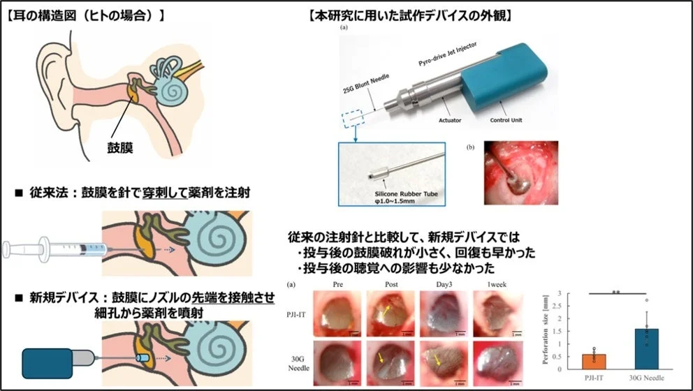 耳の構造図とジェットインジェクター